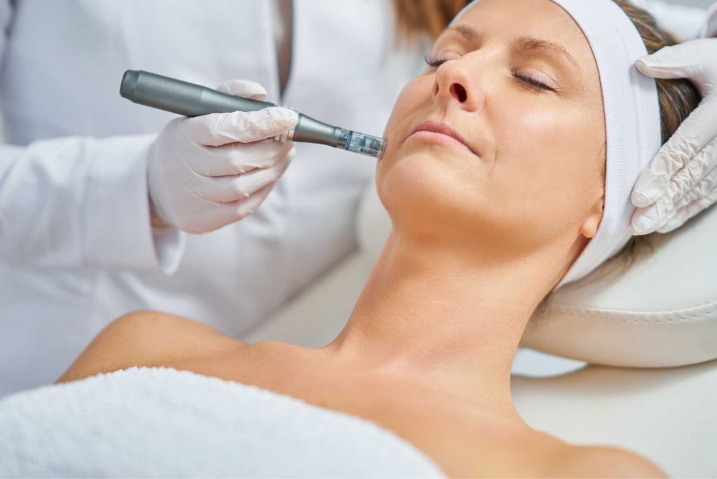 Microneedling